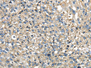 The image on the left is immunohistochemistry of paraffin-embedded Human breast cancer tissue using CSB-PA250986(TMED1 Antibody) at dilution 1/35, on the right is treated with fusion protein. (Original magnification: ×200)