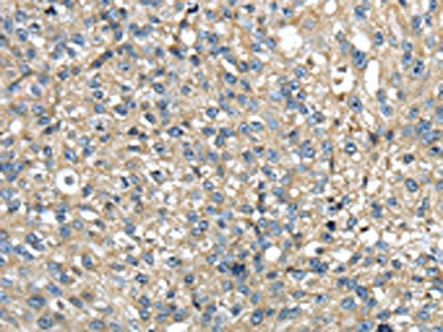 The image on the left is immunohistochemistry of paraffin-embedded Human breast cancer tissue using CSB-PA250986(TMED1 Antibody) at dilution 1/35, on the right is treated with fusion protein. (Original magnification: ×200)