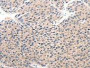 The image on the left is immunohistochemistry of paraffin-embedded Human breast cancer tissue using CSB-PA251062(SCN10A Antibody) at dilution 1/25, on the right is treated with synthetic peptide. (Original magnification: ×200)