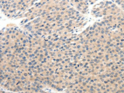 The image on the left is immunohistochemistry of paraffin-embedded Human breast cancer tissue using CSB-PA251062(SCN10A Antibody) at dilution 1/25, on the right is treated with synthetic peptide. (Original magnification: ×200)