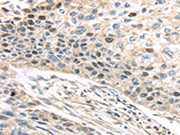 The image on the left is immunohistochemistry of paraffin-embedded Human esophagus cancer tissue using CSB-PA251071(TPX2 Antibody) at dilution 1/40, on the right is treated with fusion protein. (Original magnification: ×200)