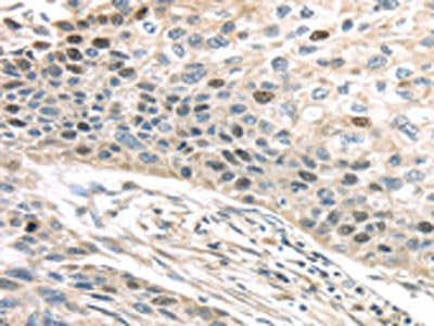 The image on the left is immunohistochemistry of paraffin-embedded Human esophagus cancer tissue using CSB-PA251071(TPX2 Antibody) at dilution 1/40, on the right is treated with fusion protein. (Original magnification: ×200)