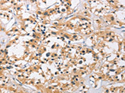 The image on the left is immunohistochemistry of paraffin-embedded Human thyroid cancer tissue using CSB-PA251074(C3AR1 Antibody) at dilution 1/50, on the right is treated with fusion protein. (Original magnification: x200)