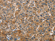 The image on the left is immunohistochemistry of paraffin-embedded Human liver cancer tissue using CSB-PA251120(TRIP4 Antibody) at dilution 1/40, on the right is treated with fusion protein. (Original magnification: ×200)