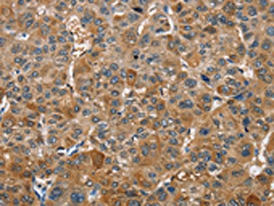 The image on the left is immunohistochemistry of paraffin-embedded Human liver cancer tissue using CSB-PA251120(TRIP4 Antibody) at dilution 1/40, on the right is treated with fusion protein. (Original magnification: ×200)