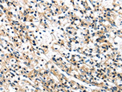 The image on the left is immunohistochemistry of paraffin-embedded Human prostate cancer tissue using CSB-PA251124(SPDL1 Antibody) at dilution 1/40, on the right is treated with synthetic peptide. (Original magnification: ×200)
