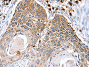 The image on the left is immunohistochemistry of paraffin-embedded Human esophagus cancer tissue using CSB-PA251137(RNF185 Antibody) at dilution 1/20, on the right is treated with fusion protein. (Original magnification: ×200)