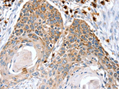 The image on the left is immunohistochemistry of paraffin-embedded Human esophagus cancer tissue using CSB-PA251137(RNF185 Antibody) at dilution 1/20, on the right is treated with fusion protein. (Original magnification: ×200)