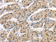 The image on the left is immunohistochemistry of paraffin-embedded Human liver cancer tissue using CSB-PA251266(TAB1 Antibody) at dilution 1/30, on the right is treated with synthetic peptide. (Original magnification: ×200)