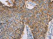The image on the left is immunohistochemistry of paraffin-embedded Human lung cancer tissue using CSB-PA251431(CDCP1 Antibody) at dilution 1/50, on the right is treated with synthetic peptide. (Original magnification: ×200)
