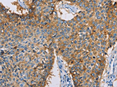 The image on the left is immunohistochemistry of paraffin-embedded Human lung cancer tissue using CSB-PA251431(CDCP1 Antibody) at dilution 1/50, on the right is treated with synthetic peptide. (Original magnification: ×200)