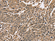 The image on the left is immunohistochemistry of paraffin-embedded Human lung cancer tissue using CSB-PA251592(PPP1CC Antibody) at dilution 1/40, on the right is treated with synthetic peptide. (Original magnification: ×200)