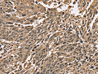 The image on the left is immunohistochemistry of paraffin-embedded Human lung cancer tissue using CSB-PA251592(PPP1CC Antibody) at dilution 1/40, on the right is treated with synthetic peptide. (Original magnification: ×200)