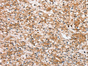 The image on the left is immunohistochemistry of paraffin-embedded Human prostate cancer tissue using CSB-PA251777(SLC25A20 Antibody) at dilution 1/30, on the right is treated with synthetic peptide. (Original magnification: ×200)