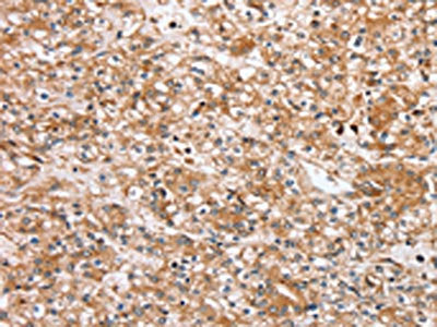 The image on the left is immunohistochemistry of paraffin-embedded Human prostate cancer tissue using CSB-PA251777(SLC25A20 Antibody) at dilution 1/30, on the right is treated with synthetic peptide. (Original magnification: ×200)