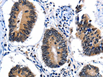 The image on the left is immunohistochemistry of paraffin-embedded Human colon cancer tissue using CSB-PA251962(CEBPG Antibody) at dilution 1/25, on the right is treated with fusion protein. (Original magnification: ×200)
