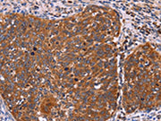 The image on the left is immunohistochemistry of paraffin-embedded Human cervical cancer tissue using CSB-PA251991(FBXW7 Antibody) at dilution 1/40, on the right is treated with fusion protein. (Original magnification: ×200)