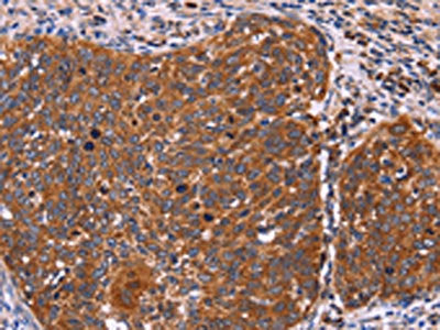 The image on the left is immunohistochemistry of paraffin-embedded Human cervical cancer tissue using CSB-PA251991(FBXW7 Antibody) at dilution 1/40, on the right is treated with fusion protein. (Original magnification: ×200)