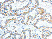 The image on the left is immunohistochemistry of paraffin-embedded Human thyroid cancer tissue using CSB-PA252519(ADAM2 Antibody) at dilution 1/15, on the right is treated with fusion protein. (Original magnification: ×200)