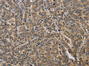 The image on the left is immunohistochemistry of paraffin-embedded Human liver cancer tissue using CSB-PA252563(KCNMB2 Antibody) at dilution 1/40, on the right is treated with synthetic peptide. (Original magnification: ×200)