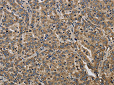 The image on the left is immunohistochemistry of paraffin-embedded Human liver cancer tissue using CSB-PA252563(KCNMB2 Antibody) at dilution 1/40, on the right is treated with synthetic peptide. (Original magnification: ×200)