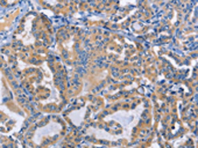 The image on the left is immunohistochemistry of paraffin-embedded Human thyroid cancer tissue using CSB-PA252610(DOK4 Antibody) at dilution 1/50, on the right is treated with fusion protein. (Original magnification: ×200)