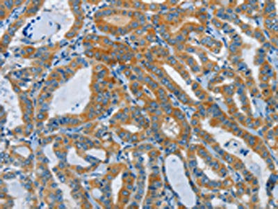 The image on the left is immunohistochemistry of paraffin-embedded Human thyroid cancer tissue using CSB-PA252663(DDAH1 Antibody) at dilution 1/55, on the right is treated with synthetic peptide. (Original magnification: ×200)