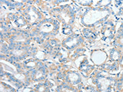 The image on the left is immunohistochemistry of paraffin-embedded Human thyroid cancer tissue using CSB-PA252711(AGBL2 Antibody) at dilution 1/25, on the right is treated with fusion protein. (Original magnification: ×200)