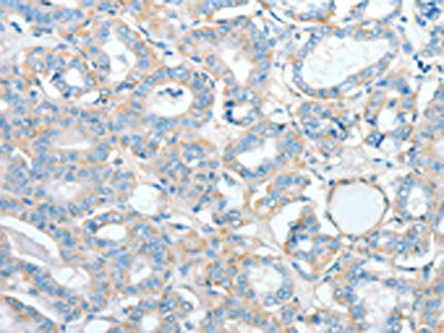 The image on the left is immunohistochemistry of paraffin-embedded Human thyroid cancer tissue using CSB-PA252711(AGBL2 Antibody) at dilution 1/25, on the right is treated with fusion protein. (Original magnification: ×200)