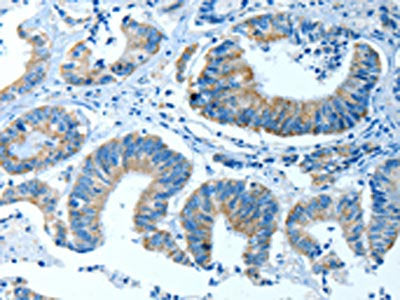 The image on the left is immunohistochemistry of paraffin-embedded Human colon cancer tissue using CSB-PA252846(ALDH4A1 Antibody) at dilution 1/35, on the right is treated with fusion protein. (Original magnification: ×200)