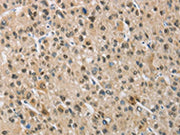 The image on the left is immunohistochemistry of paraffin-embedded Human liver cancer tissue using CSB-PA252963(NAPSA Antibody) at dilution 1/50, on the right is treated with fusion protein. (Original magnification: ×200)