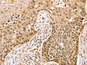 The image on the left is immunohistochemistry of paraffin-embedded Human esophagus cancer tissue using CSB-PA253060(SMARCA2 Antibody) at dilution 1/20, on the right is treated with synthetic peptide. (Original magnification: ×200)