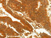 The image on the left is immunohistochemistry of paraffin-embedded Human colon cancer tissue using CSB-PA253076(NAPA Antibody) at dilution 1/35, on the right is treated with fusion protein. (Original magnification: ×200)
