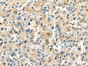 The image on the left is immunohistochemistry of paraffin-embedded Human liver cancer tissue using CSB-PA253236(TRAIP Antibody) at dilution 1/40, on the right is treated with fusion protein. (Original magnification: ×200)