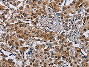The image on the left is immunohistochemistry of paraffin-embedded Human liver cancer tissue using CSB-PA253259(GTF2I Antibody) at dilution 1/40, on the right is treated with synthetic peptide. (Original magnification: ×200)