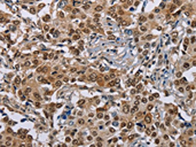The image on the left is immunohistochemistry of paraffin-embedded Human liver cancer tissue using CSB-PA253259(GTF2I Antibody) at dilution 1/40, on the right is treated with synthetic peptide. (Original magnification: ×200)