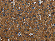 The image on the left is immunohistochemistry of paraffin-embedded Human liver cancer tissue using CSB-PA253485(PCK2 Antibody) at dilution 1/60, on the right is treated with fusion protein. (Original magnification: ×200)