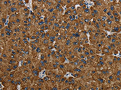 The image on the left is immunohistochemistry of paraffin-embedded Human liver cancer tissue using CSB-PA253485(PCK2 Antibody) at dilution 1/60, on the right is treated with fusion protein. (Original magnification: ×200)