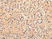 The image on the left is immunohistochemistry of paraffin-embedded Human liver cancer tissue using CSB-PA253608(ATP7B Antibody) at dilution 1/20, on the right is treated with synthetic peptide. (Original magnification: ×200)