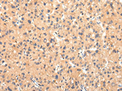 The image on the left is immunohistochemistry of paraffin-embedded Human liver cancer tissue using CSB-PA253608(ATP7B Antibody) at dilution 1/20, on the right is treated with synthetic peptide. (Original magnification: ×200)