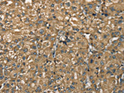 The image on the left is immunohistochemistry of paraffin-embedded Human liver cancer tissue using CSB-PA253640(NEMF Antibody) at dilution 1/30, on the right is treated with synthetic peptide. (Original magnification: ×200)