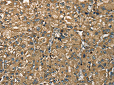 The image on the left is immunohistochemistry of paraffin-embedded Human liver cancer tissue using CSB-PA253640(NEMF Antibody) at dilution 1/30, on the right is treated with synthetic peptide. (Original magnification: ×200)