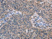 The image on the left is immunohistochemistry of paraffin-embedded Human lung cancer tissue using CSB-PA253689(RNF144B Antibody) at dilution 1/50, on the right is treated with fusion protein. (Original magnification: ×200)