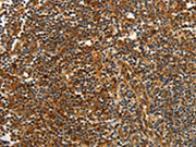 The image on the left is immunohistochemistry of paraffin-embedded Human tonsil tissue using CSB-PA254306(CNNM3 Antibody) at dilution 1/40, on the right is treated with fusion protein. (Original magnification: ×200)