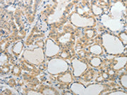 The image on the left is immunohistochemistry of paraffin-embedded Human thyroid cancer tissue using CSB-PA254368(UCN Antibody) at dilution 1/20, on the right is treated with synthetic peptide. (Original magnification: ×200)