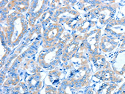 The image on the left is immunohistochemistry of paraffin-embedded Human thyroid cancer tissue using CSB-PA254568(ALDH3B1 Antibody) at dilution 1/30, on the right is treated with fusion protein. (Original magnification: ×200)