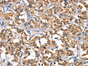 The image on the left is immunohistochemistry of paraffin-embedded Human thyroid cancer tissue using CSB-PA254609(HGF Antibody) at dilution 1/65, on the right is treated with fusion protein. (Original magnification: ×200)