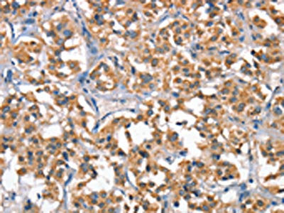 The image on the left is immunohistochemistry of paraffin-embedded Human thyroid cancer tissue using CSB-PA254609(HGF Antibody) at dilution 1/65, on the right is treated with fusion protein. (Original magnification: ×200)