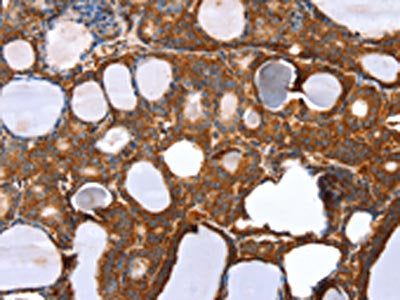 The image on the left is immunohistochemistry of paraffin-embedded Human thyroid cancer tissue using CSB-PA254703(RNF11 Antibody) at dilution 1/20, on the right is treated with fusion protein. (Original magnification: ×200)