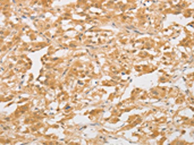 The image on the left is immunohistochemistry of paraffin-embedded Human thyroid cancer tissue using CSB-PA254759(CD24 Antibody) at dilution 1/40, on the right is treated with synthetic peptide. (Original magnification: ×200)